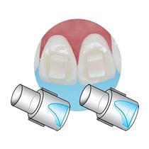 Ortho - Mini-Mold Bite-Ramp Tips